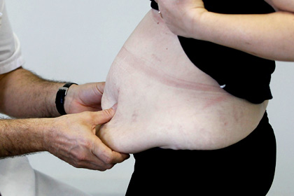 Ожирение обходится миру в 2 триллиона долларов в год