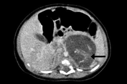 Новорожденная гонконгская девочка оказалась беременной двумя братьями