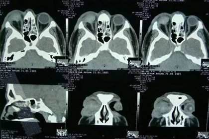 Охранники бара на Бали выбили глаз российскому туристу