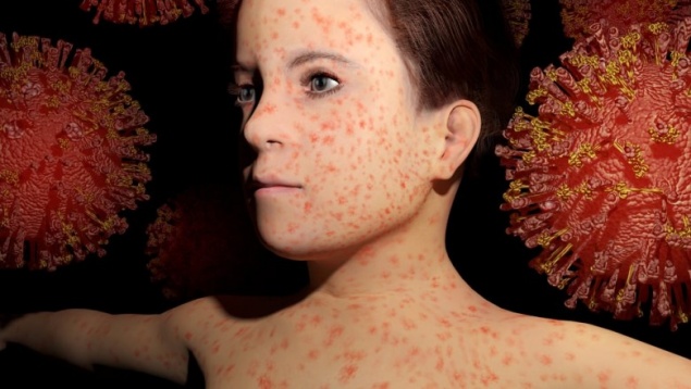 Вспышка кори коснется россиян из-за отсутствия плановой вакцинации