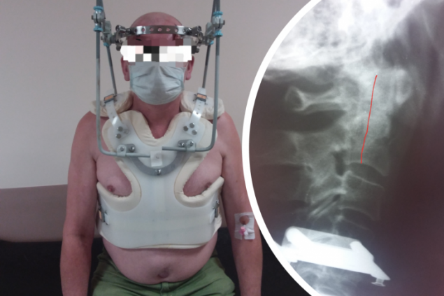 Мужчина упал со стремянки и через 2 недели пришел к врачам с головной болью. С такой травмой люди обычно умирают